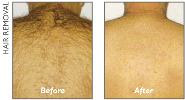 back hair removal victoria