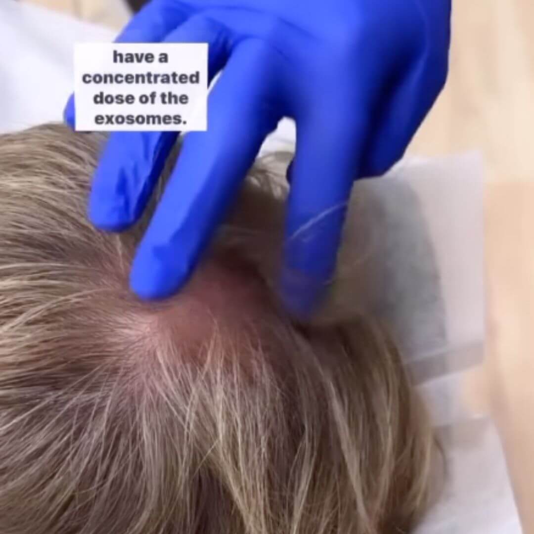 Services Calgary Scalp Treatments & Hair Growth Reveal Laser