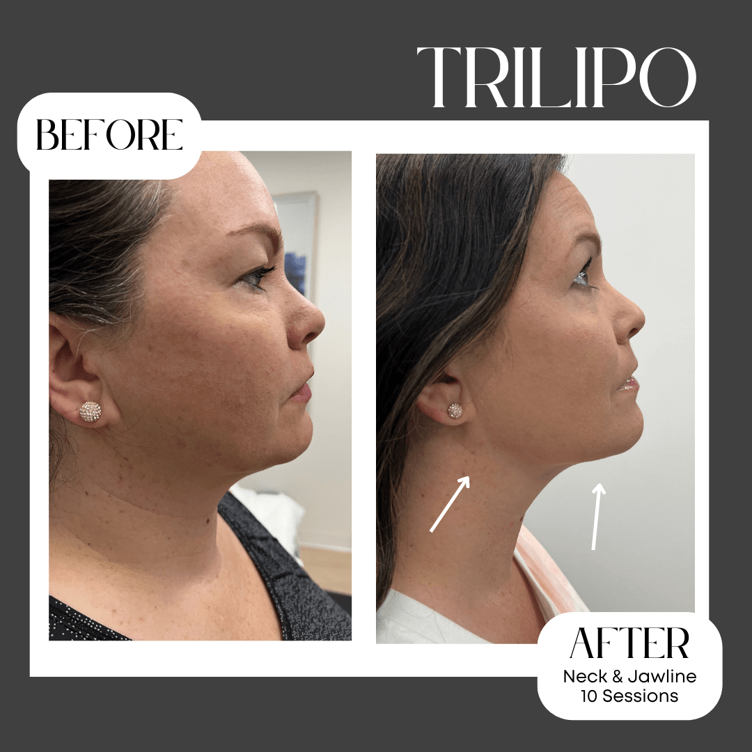 BEFOREAFTER TEMPLATES Reveal Laser BEFOREAFTER TEMPLATES Reveal Laser