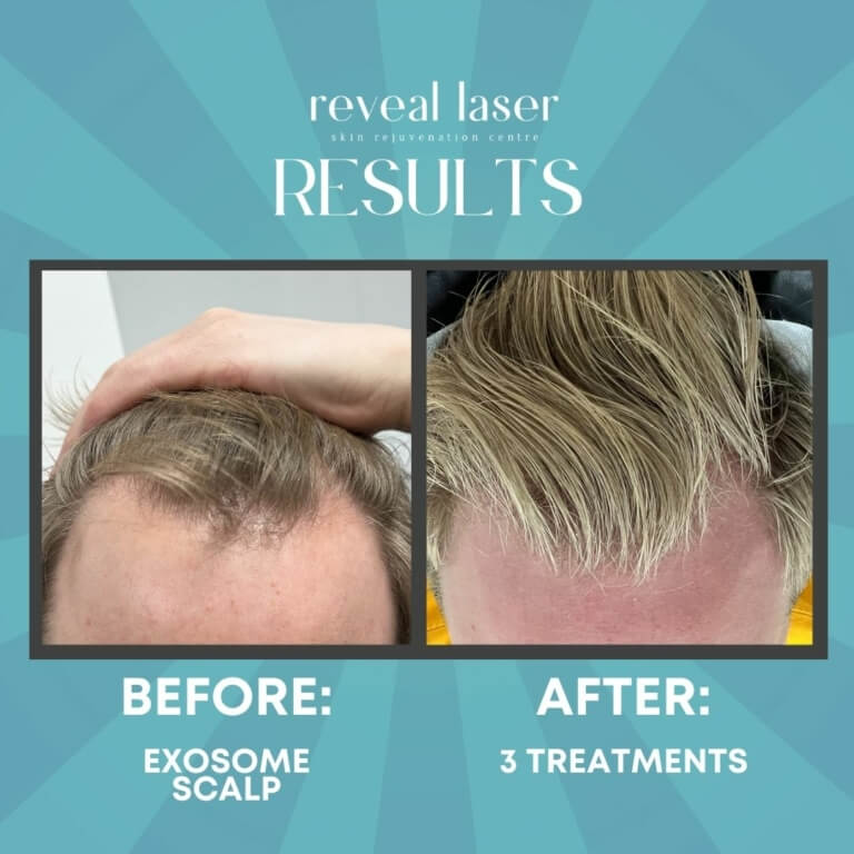 Services Calgary Scalp Treatments & Hair Growth Reveal Laser